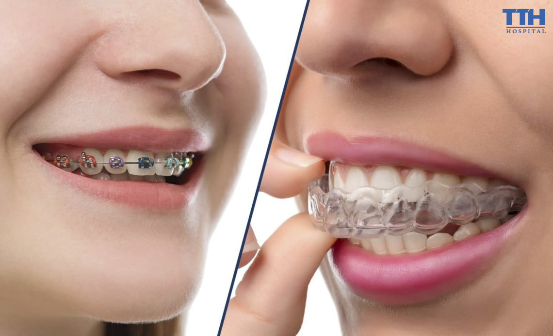 NIỀNG RĂNG MẮC CÀI VÀ NIỀNG RĂNG TRONG SUỐT INVISALIGN
