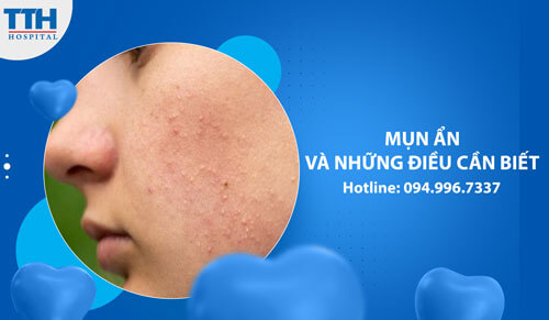 Mụn ẩn và những điều cần biết