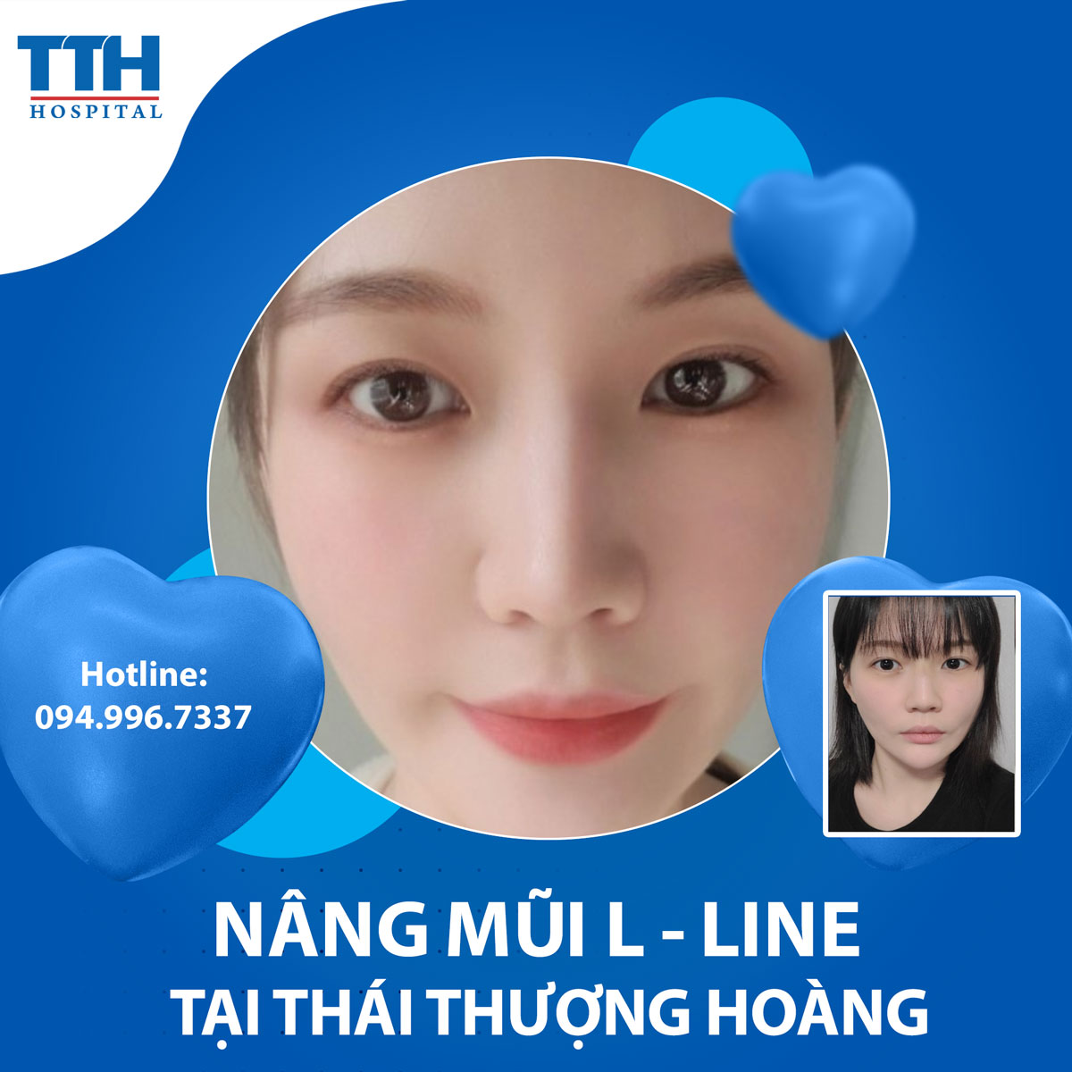 Nâng mũi L Line: Tạo dáng hoàn hảo cho vẻ đẹp khuôn mặt