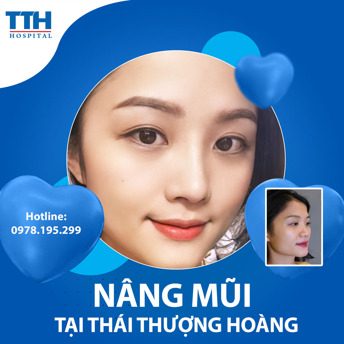 Nâng mũi và những điều cần biết trước khi làm