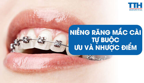 Niềng Răng Mắc Cài Tự Buộc - Ưu Và Nhược Điểm