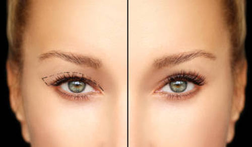 Phẫu Thuật Mí Trên Perfect Eyes TTH