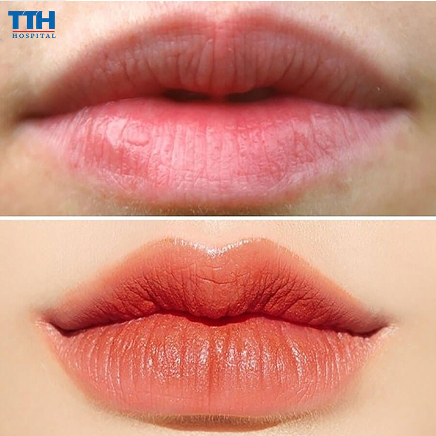 Phẫu thuật tạo hình môi trái tim