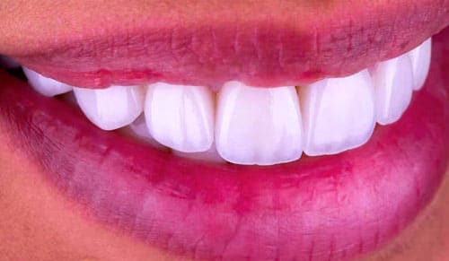 Răng sứ Orodent là gì? Tìm hiểu từ A đến Z về dòng răng sứ cao cấp này