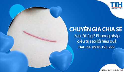Sẹo lồi là gì? Phương pháp điều trị sẹo lồi hiệu quả tại Nghệ An, Hà Tĩnh