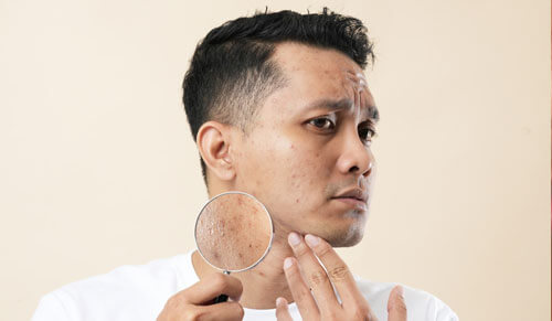 Tại Sao Nám Da Ở Nam Giới Đang Gia Tăng?