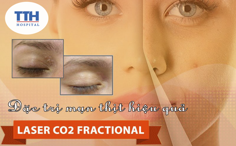 Xóa mụn thịt C02 Practionnal